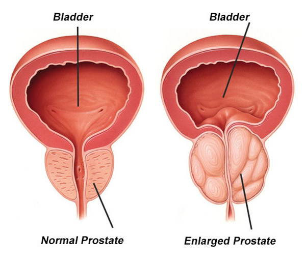 Normal vs Enlarged Prostate
